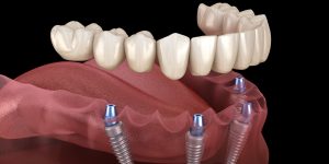 A Comprehensive Guide to Dental Implants in Teddington